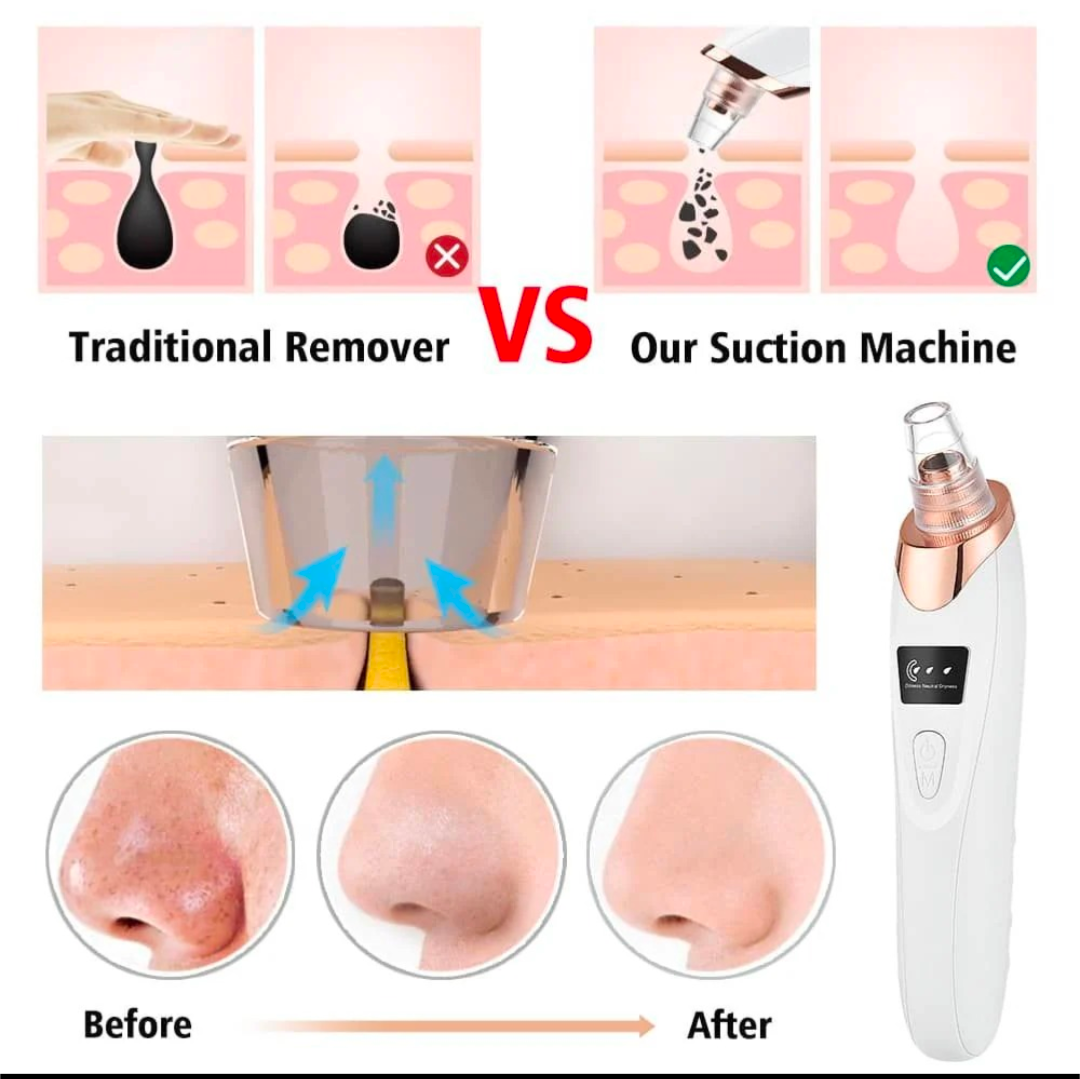 5in1 Blackhead Remover Machine Rechargeable | Face Vacuum Derma Suction With 5 Heads | Blackhead Removing Machine